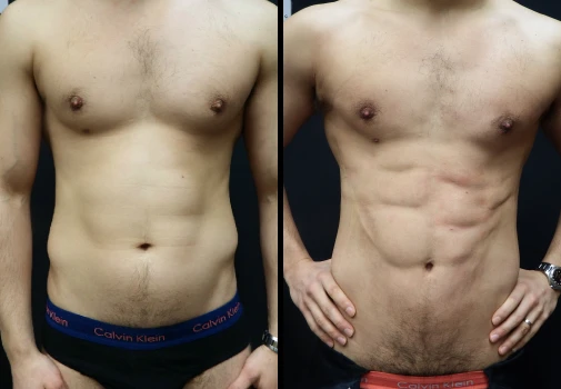 jason-before-and-after-vaser-lipo-patient