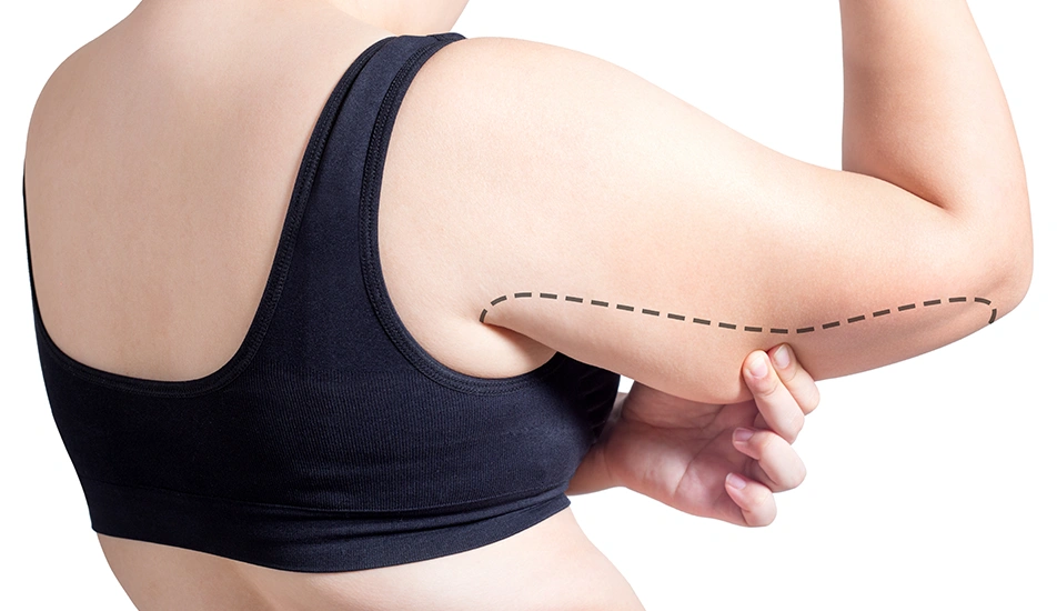 Close-up of woman in black sports bra with surgical markings on upper arm before Vaser liposuction