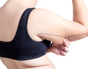 Vaser Liposuction for Arms