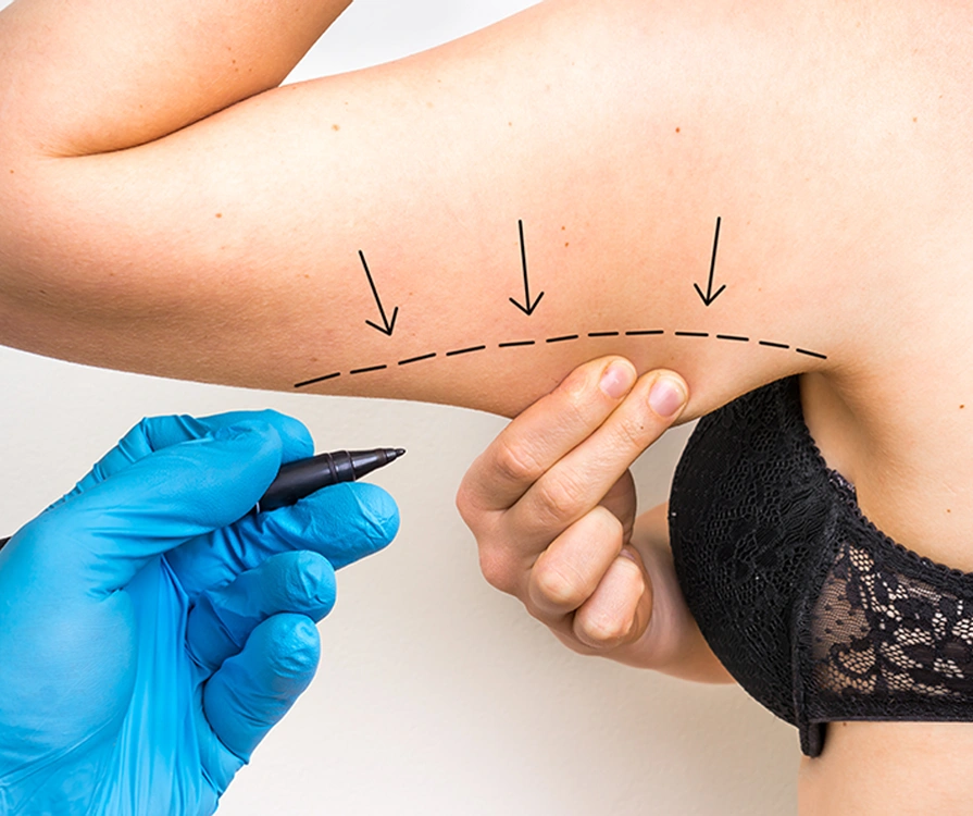 Surgeon drawing markings on female upper arm to prepare for Vaser liposuction treatment