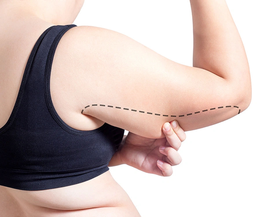 Woman in black sports bra with surgical markings on upper arm before Vaser liposuction procedure