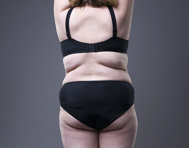 Woman showing back and flank fat before liposuction treatment.