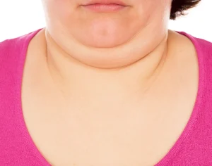 Why Should You Get Vaser Liposuction on Your Face?