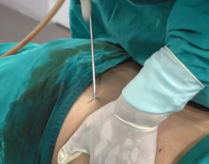 What is the difference between Vaser Liposuction & the Other Methods of Liposuction