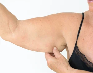 Why Should You Get Vaser Liposuction On Your Arms?