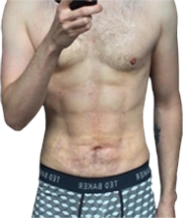 male after vaser lipo