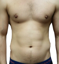 male before vaser lipo-2