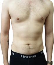 male before vaser lipo