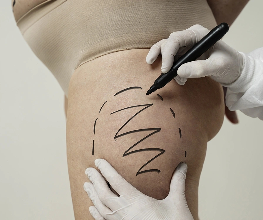 Close-up of surgeon’s gloved hands marking thigh area before Vaser liposuction procedure