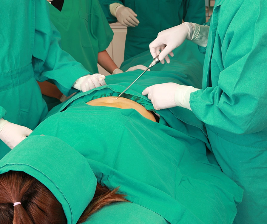 Team of surgeons performing Vaser liposuction procedure on patient in operating theatre