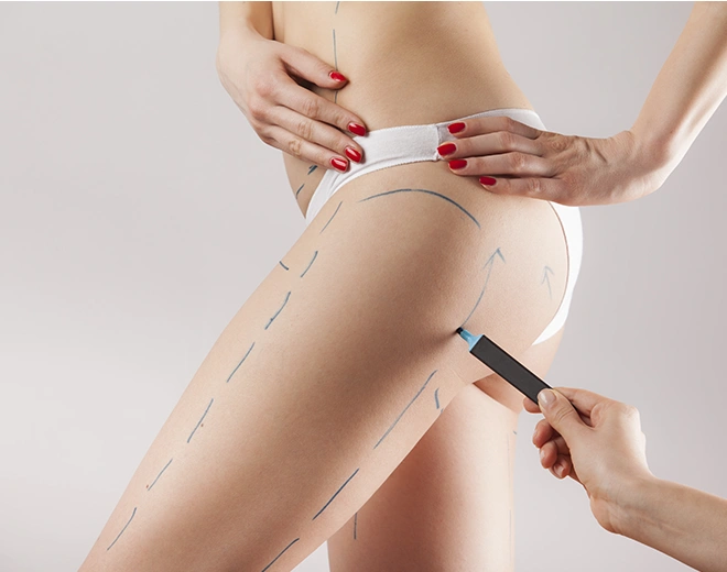Close-up of a woman’s thighs with surgical markings before liposuction or body contouring procedure