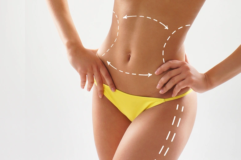 Close-up of female waist with surgical markings showing treatment areas for Vaser liposuction