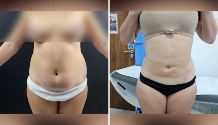 vaser lipo before and after