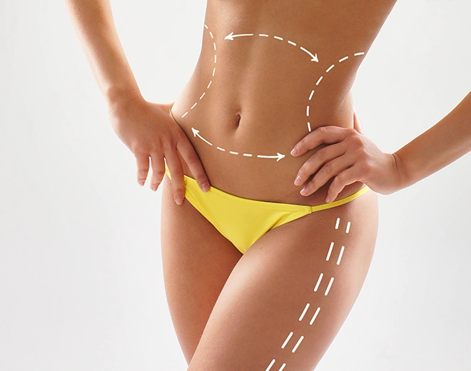 Close-up of female body with surgical markings for liposuction on abdomen and thighs