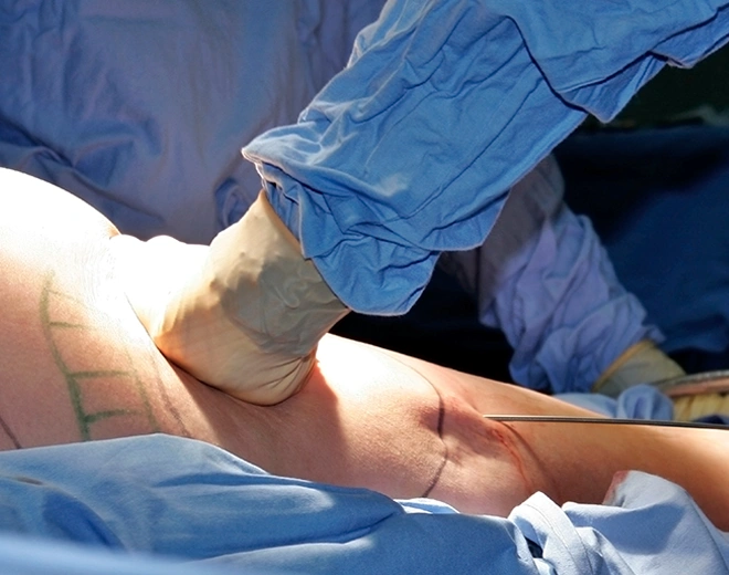 Close-up of surgeon performing Vaser liposuction on patient’s thigh during procedure