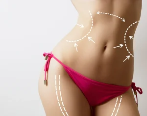 What is Vaser Lipo?