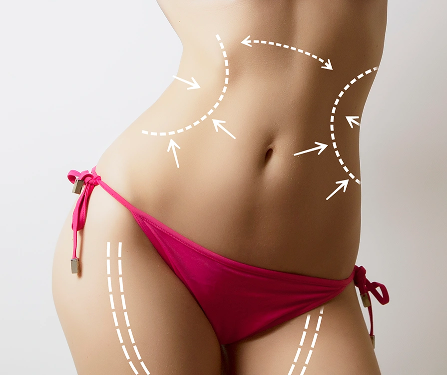 Close-up of slim woman with surgical contouring lines on stomach and thighs for Vaser liposuction treatment
