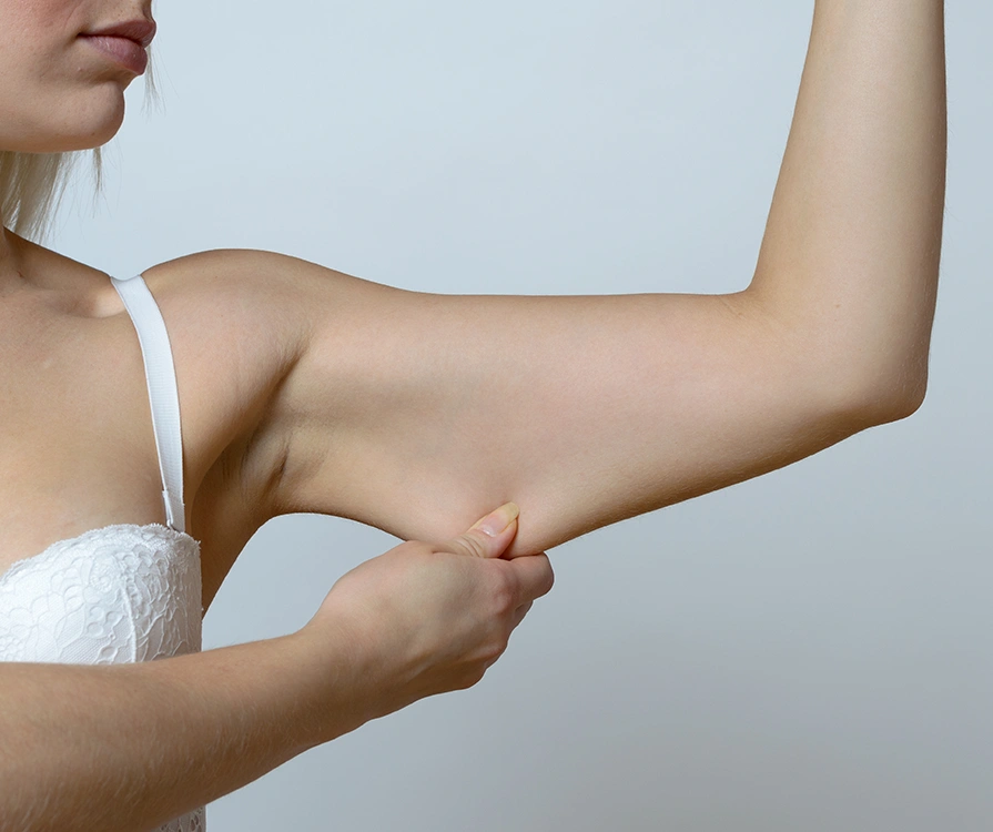 Close-up of woman in white bra pinching loose skin and excess fat on upper arm before Vaser liposuction