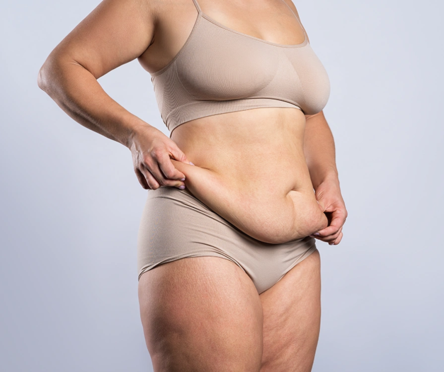 Overweight woman in underwear pinching belly fat showing need for Vaser liposuction treatment